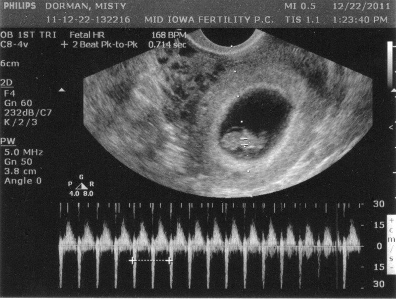 Bắt đầu hành trình hình ảnh siêu âm thai nhi 8 tuần tuổi cùng tìm hiểu