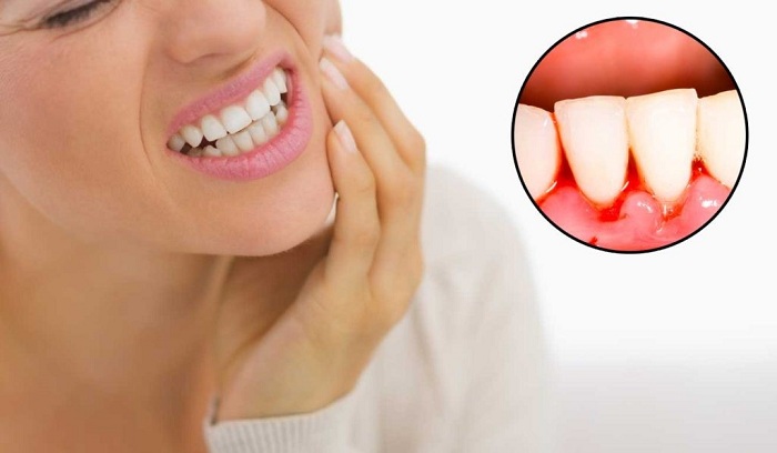 Có những nguyên nhân tự nhiên nào khiến chân răng dễ chảy máu?
