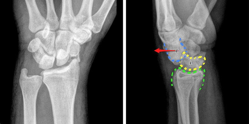 Chụp X - quang cổ tay được thực hiện thế nào để mang lại hiệu quả