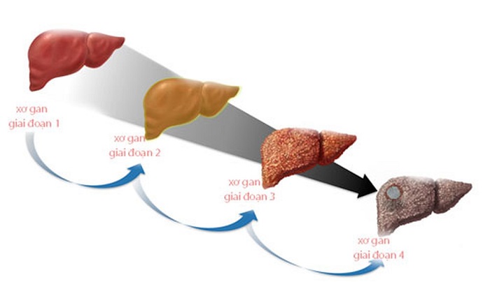 Tìm hiểu về các giai đoạn xơ gan Nguyên nhân và cách điều trị