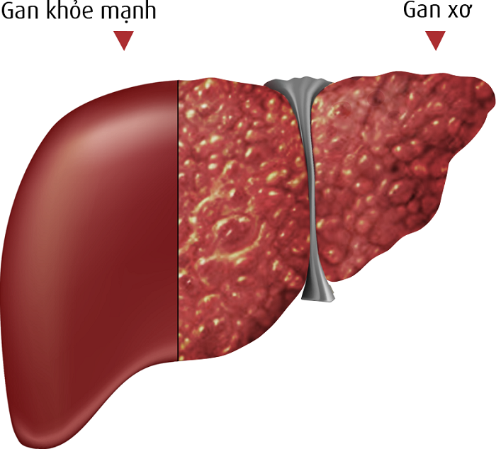 Xơ gan độ 3 có thể phục hồi được không?
