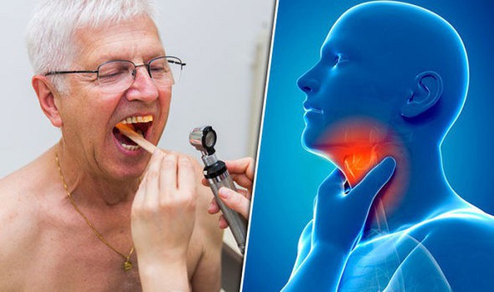 Các loại ung thư vòm họng ở độ tuổi nào phổ biến và nguy hiểm