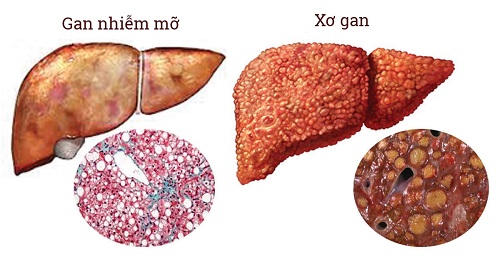 Illustration about xơ gan độ 2 and appropriate treatments