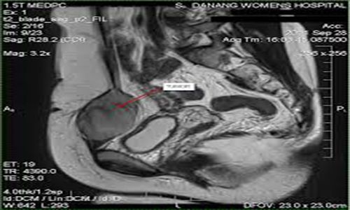 Chụp cộng hưởng từ tiểu khung tại Bệnh viện MEDLATEC