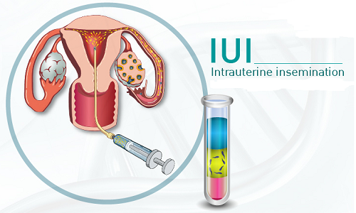 IUI là kỹ thuật bơm tinh trùng vào trong tử cung