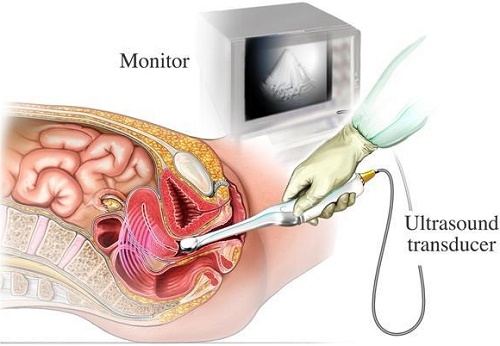 Siêu âm đầu dò là gì? Vì sao cần thực hiện kỹ thuật này?