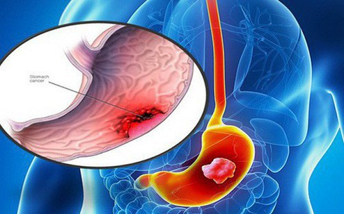 Nội soi dạ dày là gì và như thế nào nó được sử dụng trong tầm soát ung thư dạ dày?
