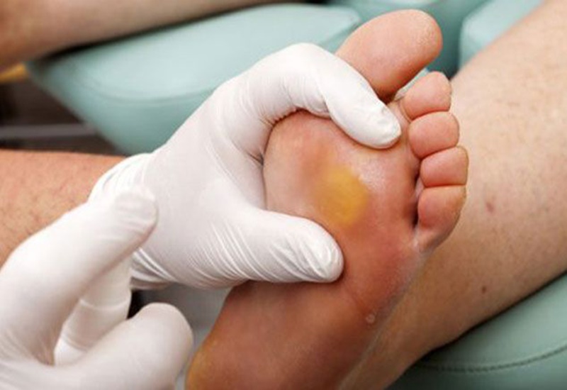 Hướng dẫn chăm sóc vết chai ở lòng bàn chân bị đau dễ dàng nhất