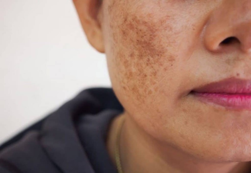 Rối loạn sắc tố da có nguy hiểm cho sức khỏe không?