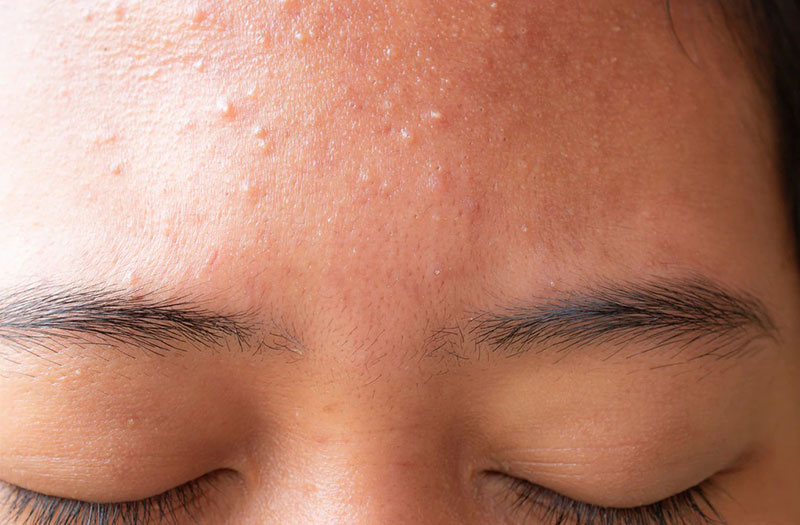 Da mặt bị khô ngứa sần sùi - nguyên nhân và cách điều trị