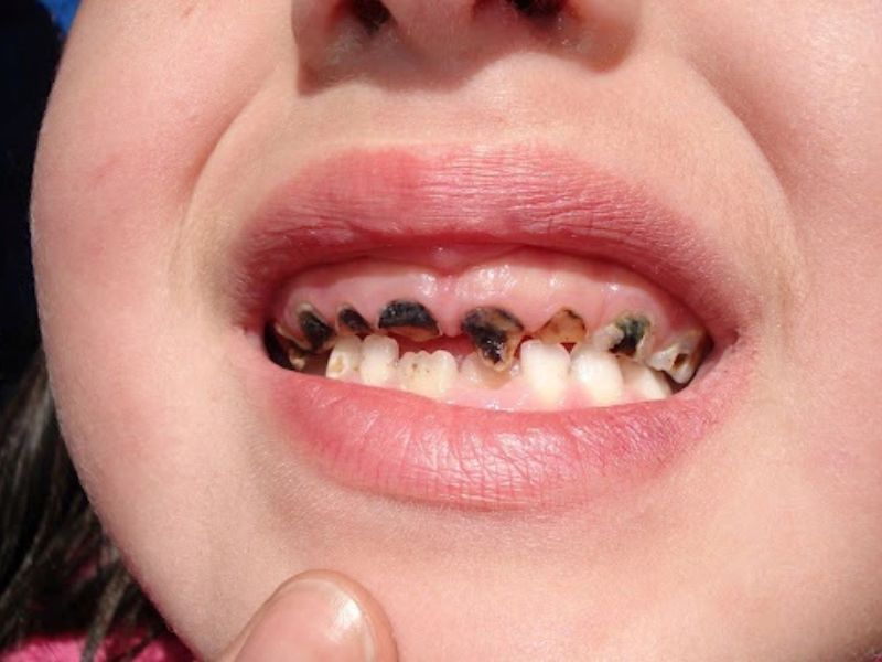 Răng trẻ bị đen phải xứ trí thế nào?
