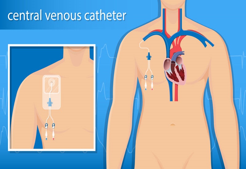 đặt catheter tĩnh mạch trung tâm