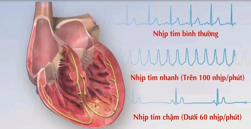 Sự kiện đốt điện tim là gì và những tác động của nó lên tim mạch
