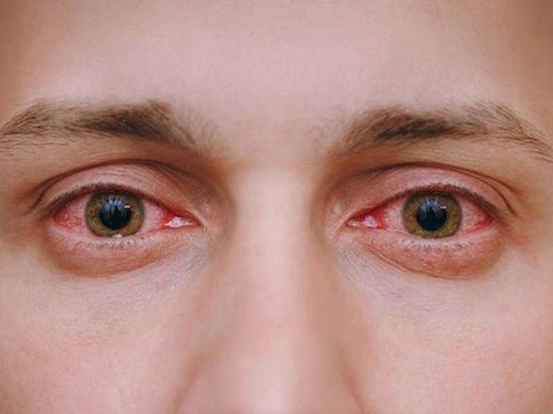 Nguyên nhân chính khiến mắt bị đỏ và cộm là gì?
