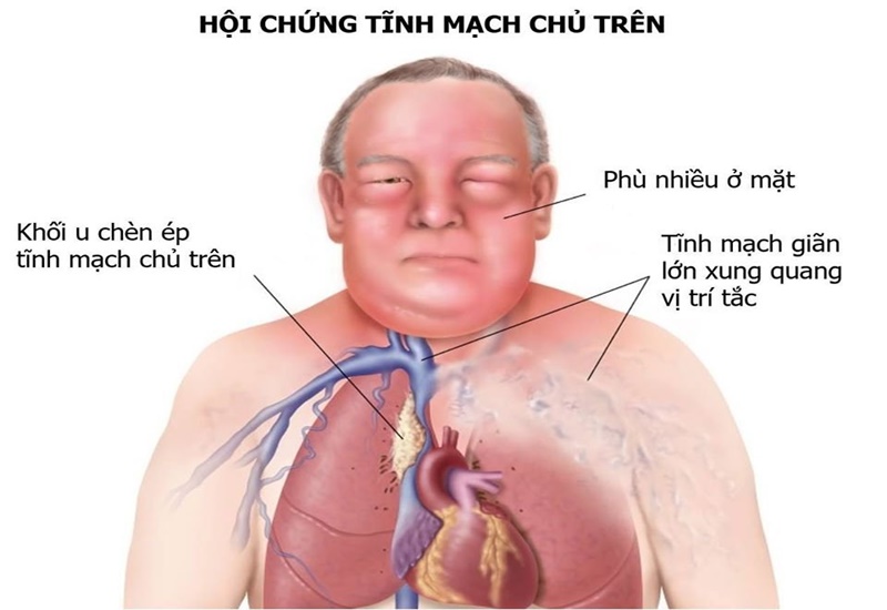 Các vấn đề liên quan đến tĩnh mạch tim Nguyên nhân và cách điều trị