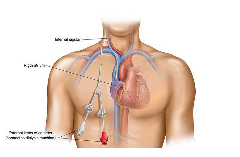 Cách thực hiện quy trình đặt catheter tĩnh mạch trung tâm và cách điều trị