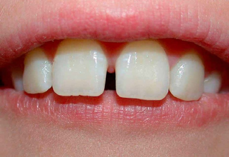 Nguyên nhân và phương pháp xử lý răng cửa thưa hiệu quả