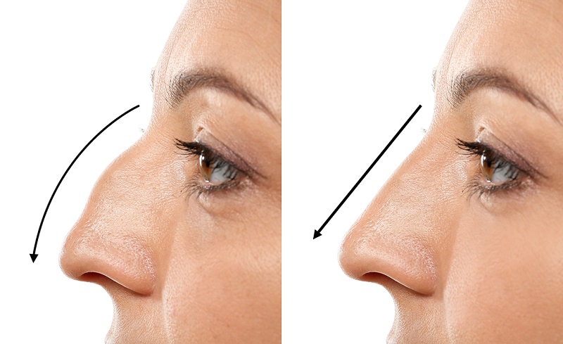 Can thiệp tới cấu trúc mũi có thể khắc phục nhiều nhược điểm