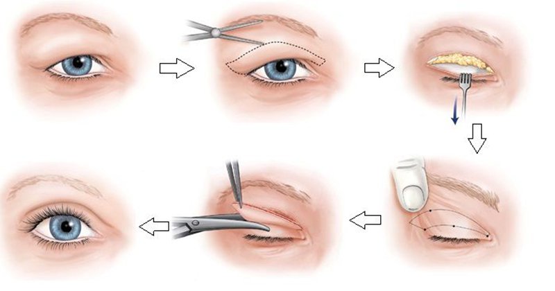 Mô tả quy trình phẫu thuật cắt mí mắt lót để tạo mí mắt mới sâu và đẹp