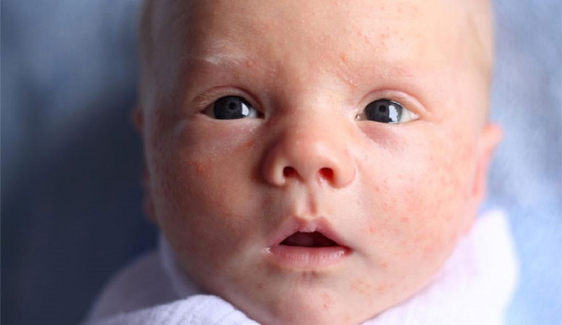Mụn sữa ở trẻ sơ sinh có thể do tác dụng phụ của thuốc đang điều trị