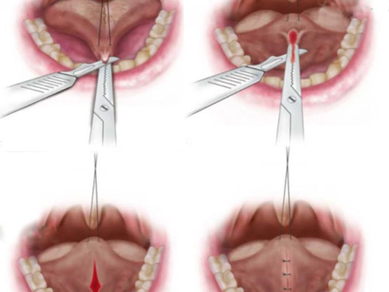 Phẫu thuật là phương pháp điều trị dính thắng lưỡi hiệu quả