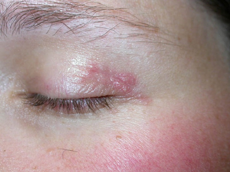 Viêm da tiếp xúc có thể là nguyên nhân khiến vùng da quanh mắt bị đỏ rát