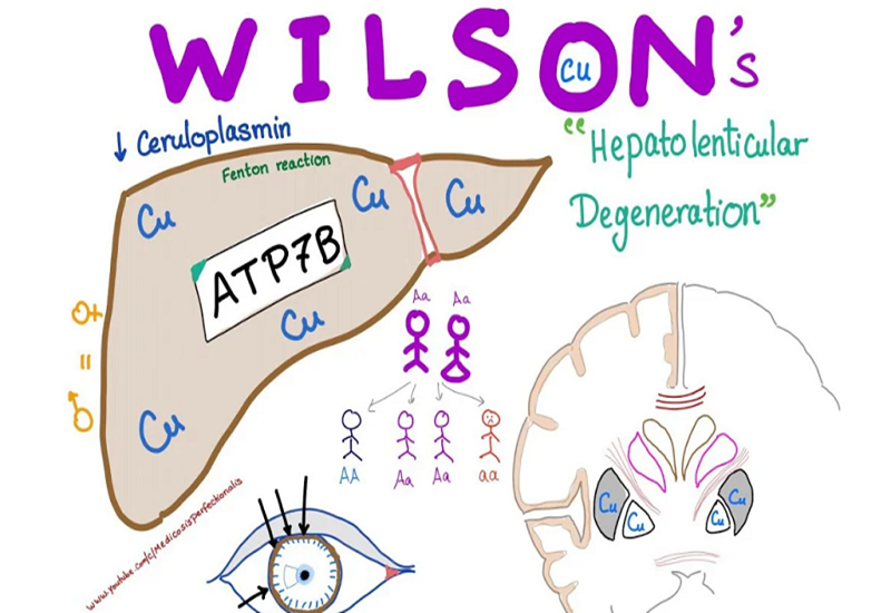 Xét nghiệm Ceruloplasmin rất quan trọng trong chẩn đoán bệnh Wilson