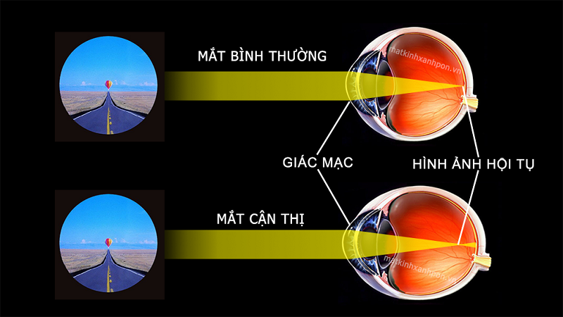 Mô phỏng về vị trí nhận hình ảnh ở mắt người bị cận thị