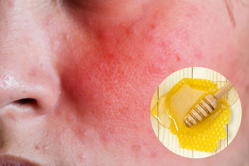 Làm dịu làn da kích ứng nhờ vitamin, axit béo và khoáng chất của mật ong