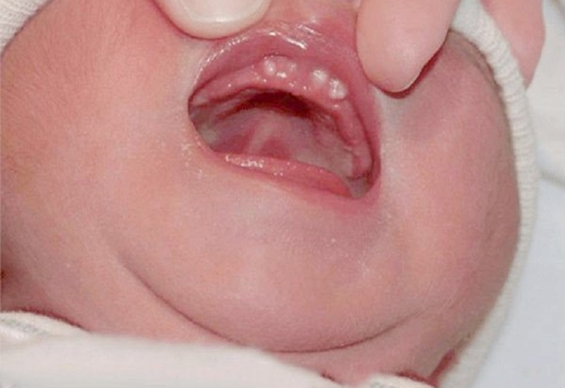 Nanh sữa ở trẻ sơ sinh và cách xử lý an toàn, hiệu quả