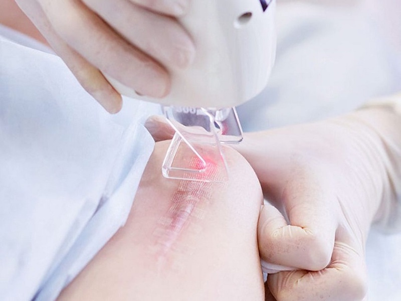 Phương pháp laser mang lại hiệu quả tốt khi điều trị sẹo có kích thước lớn
