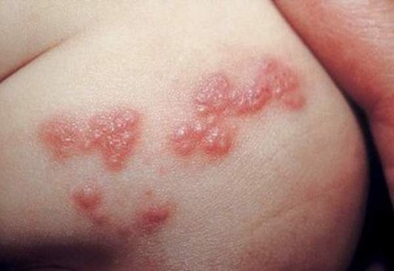 Những vùng da bị bệnh xảy ra tình trạng ngứa và lở loét