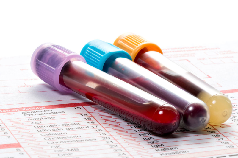 Mỡ máu - chỉ số trong xét nghiệm sinh hóa máu đo lượng mỡ có trong huyết thanh