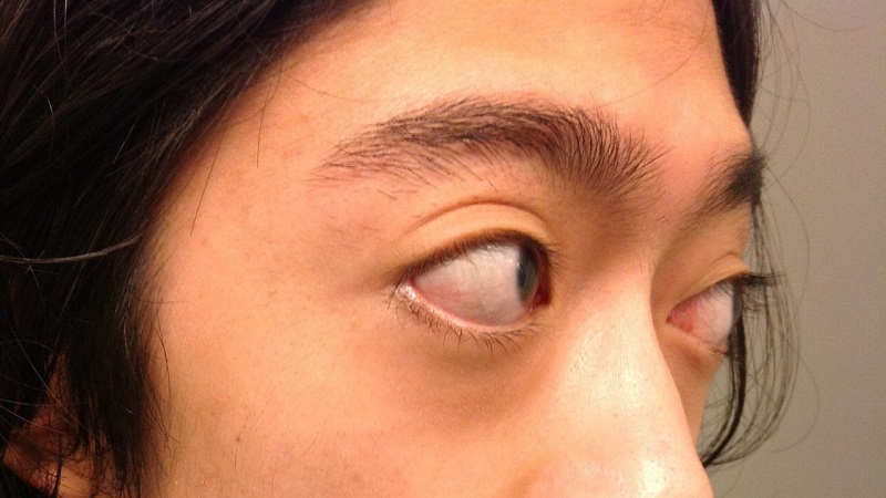 Mắt lồi là dấu hiệu đặc trưng ở bệnh nhân basedow 2. Cách điều trị cường giáp Basedow