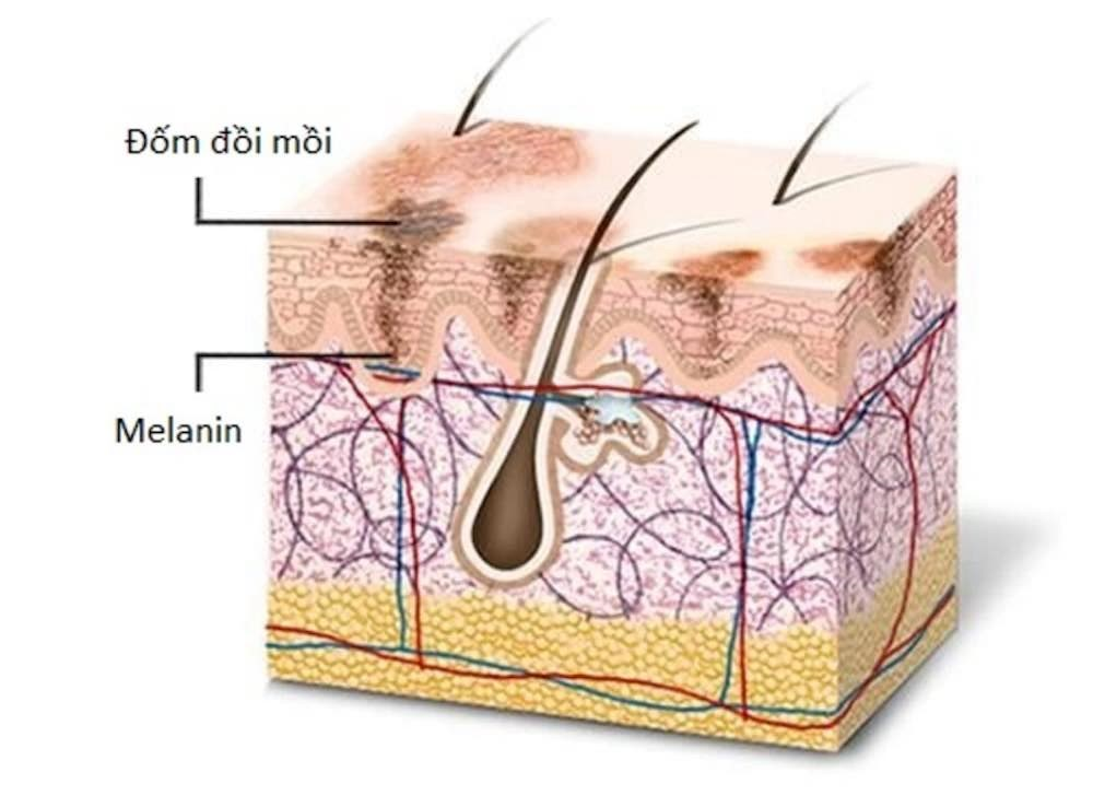 Sự tập trung hắc tố melanin quá mức tạo nên đốm sậm màu trên da