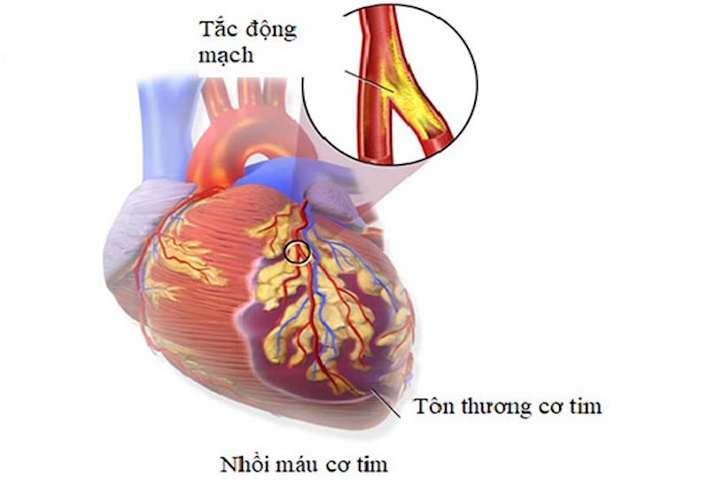 Nhồi máu cơ tim khiến tim bị tổn thương nghiêm trọng