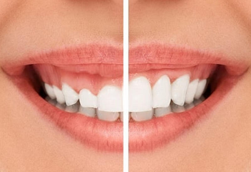 Hình ảnh mô phỏng trước và sau khi cắt lợi