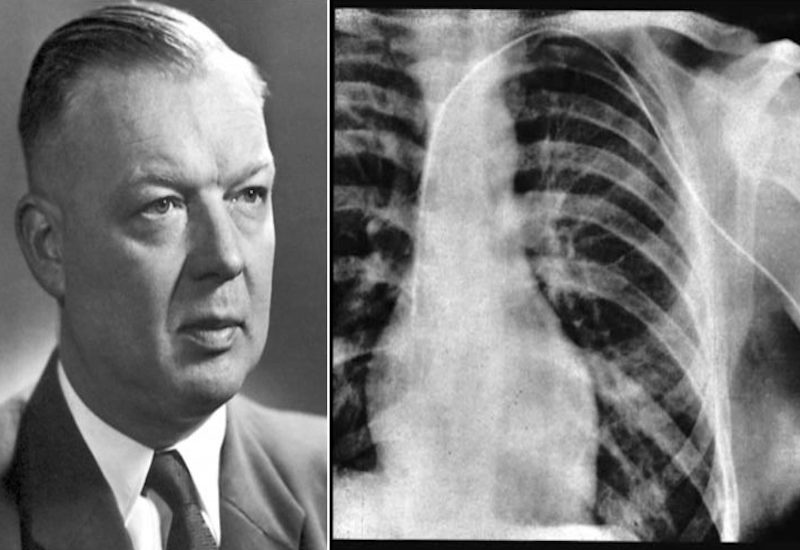 Forssmann và ảnh chụp X-quang ca thông tin đầu tiên do chính ông thực hiện trên cơ thể mình
