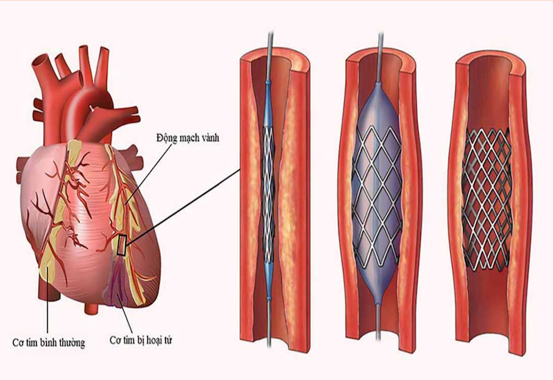 Đặt Stent mạch vành giúp “giải cứu” và hồi sinh trái tim