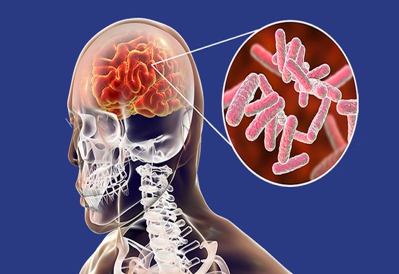 Viêm não tiên phát xảy ra khi virus tấn công trực tiếp vào não bộ