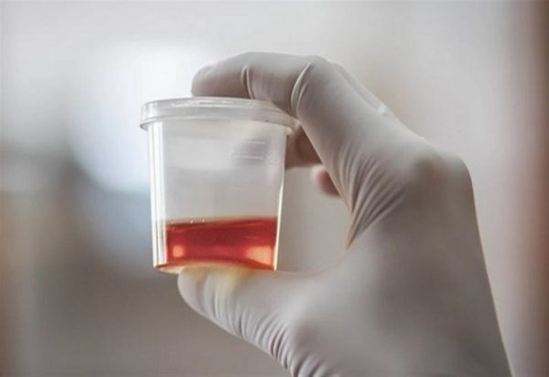 Tìm hiểu chỉ số hồng cầu trong nước tiểu hiệu quả và an toàn