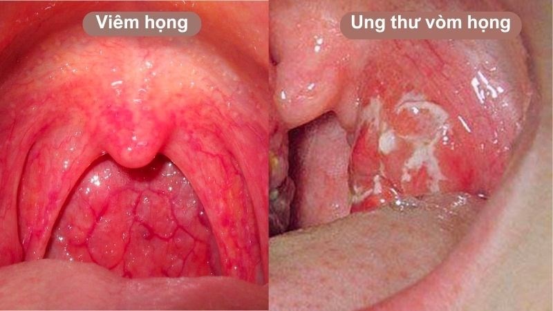 Triệu chứng ung thư vòm họng ở người lớn: Dấu hiệu sớm và cách phòng ngừa