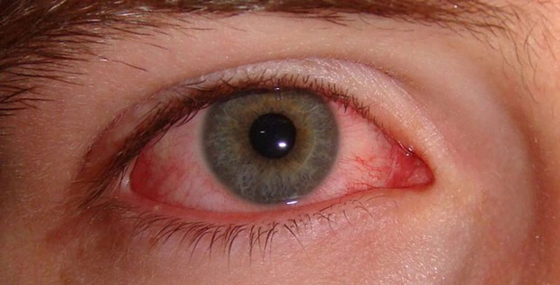 Mắt dễ bị khô bởi nhiều nguyên nhân khác nhau