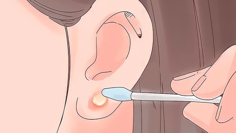 Cách chữa bấm lỗ tai bị mưng mủ tại nhà đơn giản nhất là giữ nguyên khuyên tai sau đó tiến hành sát khuẩn sạch vùng mưng mủ