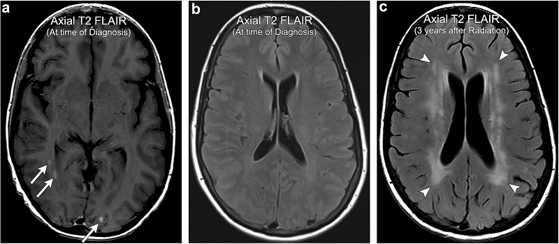Hình ảnh chụp MRI giúp chẩn đoán thoái hóa chất trắng