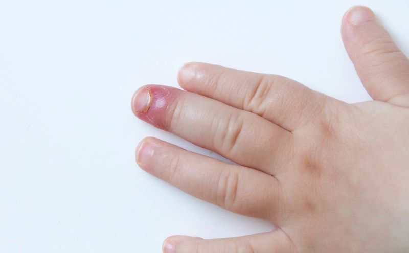 Viêm quanh móng tay có thể do sự tấn công của vi khuẩn hoặc nấm