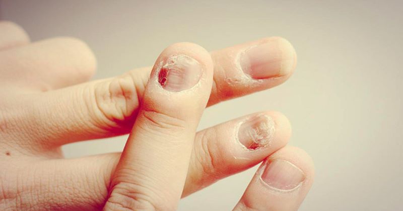 Nấm móng tay có khả năng lây lan và tái nhiễm cao