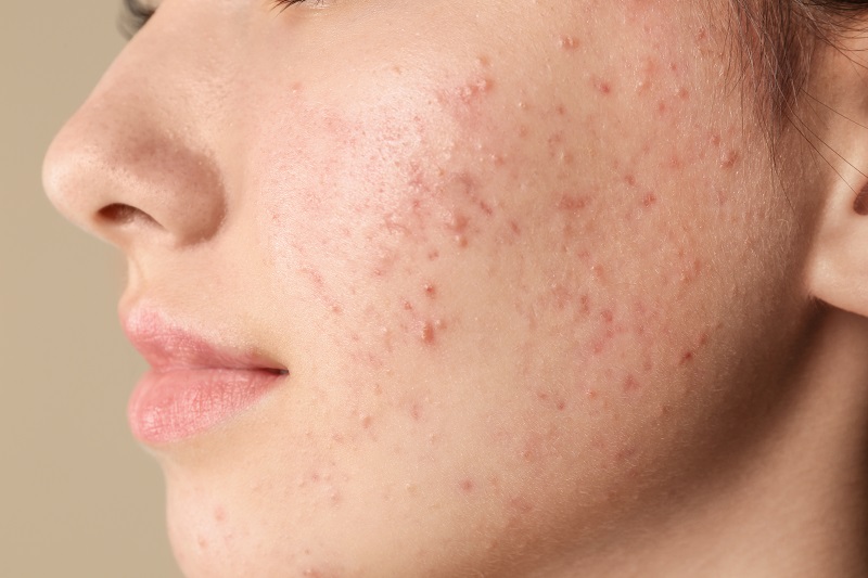 Nội tiết tố thay đổi có thể là lý do dẫn đến tình trạng da mặt sần sùi, nổi mụn cám