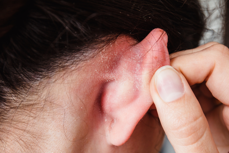 Người bị chàm ở tai thường cảm thấy khó chịu và ngứa ngáy