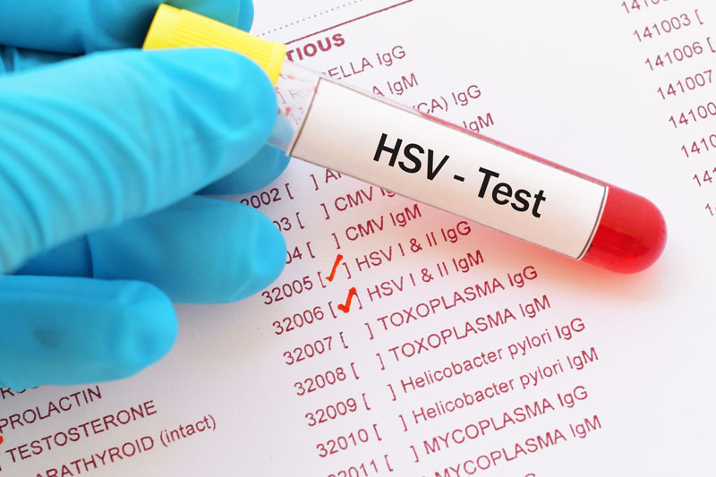 Khám sức khỏe để xét nghiệm HSV định kỳ giúp dự phòng lây nhiễm herpes